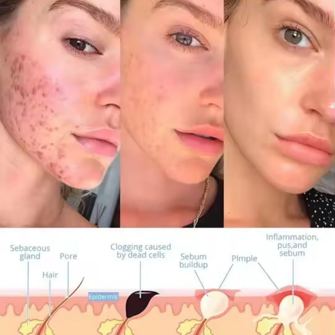 LumeThera™ - Facial Wand