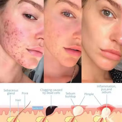 LumeThera™ - Facial Wand